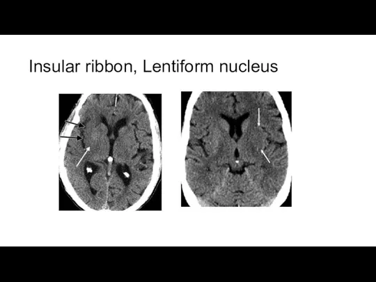 Insular ribbon, Lentiform nucleus