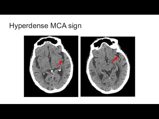 Hyperdense MCA sign