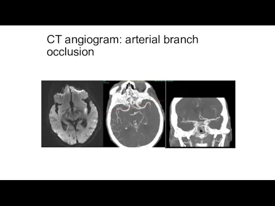 CT angiogram: arterial branch occlusion