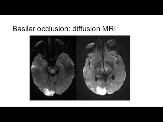 Basilar occlusion: diffusion MRI