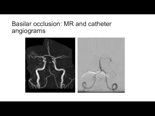 Basilar occlusion: MR and catheter angiograms