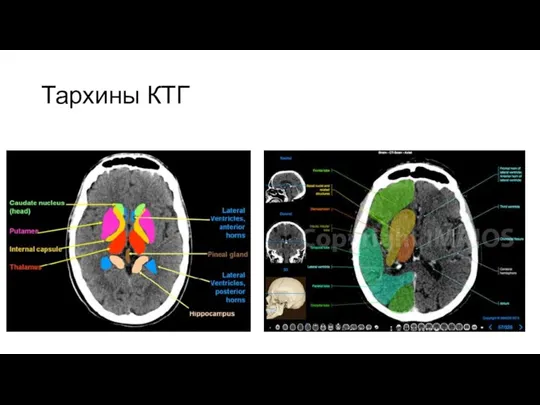 Тархины КТГ