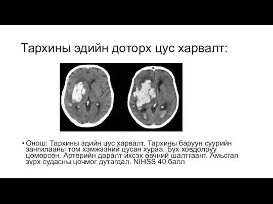 Тархины эдийн доторх цус харвалт: Онош: Тархины эдийн цус харвалт. Тархины баруун