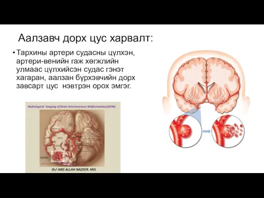 Аалзавч дорх цус харвалт: Тархины артери судасны цүлхэн, артери-венийн гаж хөгжлийн улмаас