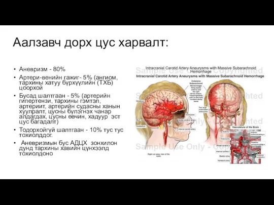 Аалзавч дорх цус харвалт: Аневризм - 80% Артери-венийн гажиг- 5% (ангиом, тархины