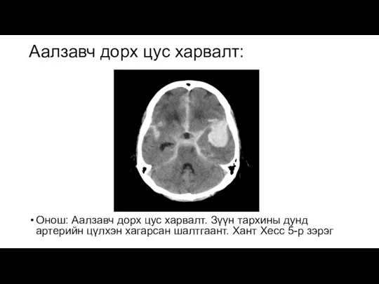 Аалзавч дорх цус харвалт: Онош: Аалзавч дорх цус харвалт. Зүүн тархины дунд