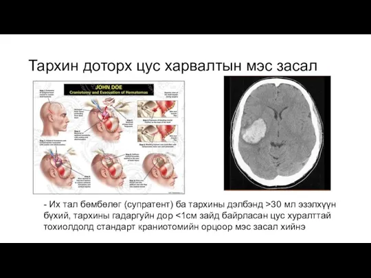 Тархин доторх цус харвалтын мэс засал - Их тал бөмбөлөг (супратент) ба