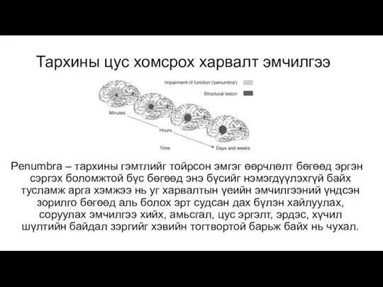 Тархины цус хомсрох харвалт эмчилгээ Penumbra – тархины гэмтлийг тойрсон эмгэг өөрчлөлт