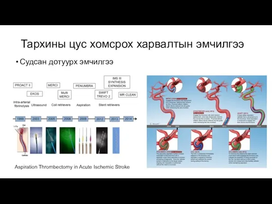 Тархины цус хомсрох харвалтын эмчилгээ Судсан дотуурх эмчилгээ Aspiration Thrombectomy in Acute Ischemic Stroke