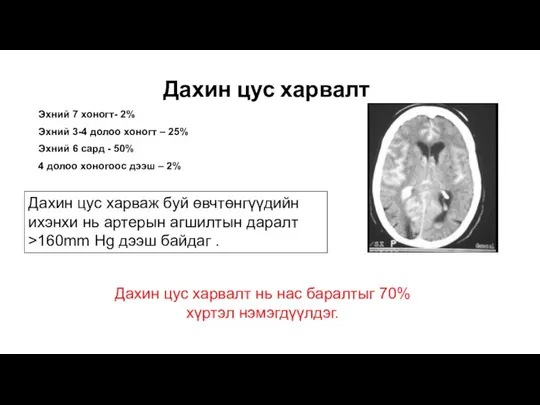 Дахин цус харвалт Дахин цус харваж буй өвчтөнгүүдийн ихэнхи нь артерын агшилтын