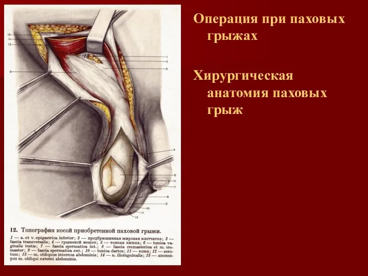 Операция при паховых грыжах Хирургическая анатомия паховых грыж