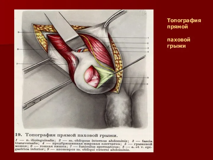 Топография прямой паховой грыжи