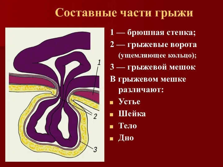 Составные части грыжи 1 — брюшная стенка; 2 — грыжевые ворота (ущемляющее