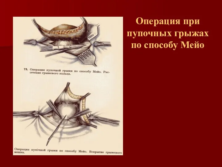 Операция при пупочных грыжах по способу Мейо