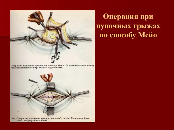 Операция при пупочных грыжах по способу Мейо