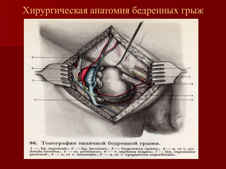 Хирургическая анатомия бедренных грыж