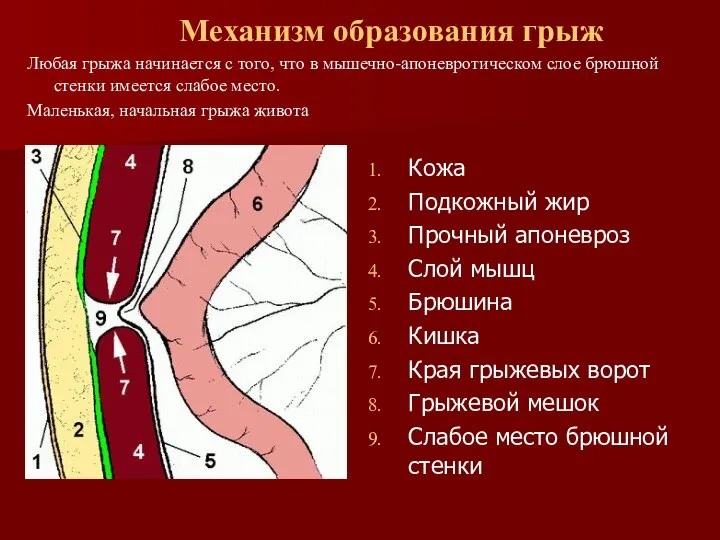 Механизм образования грыж Кожа Подкожный жир Прочный апоневроз Слой мышц Брюшина Кишка