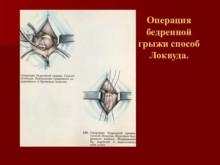 Операция бедренной грыжи способ Локвуда.