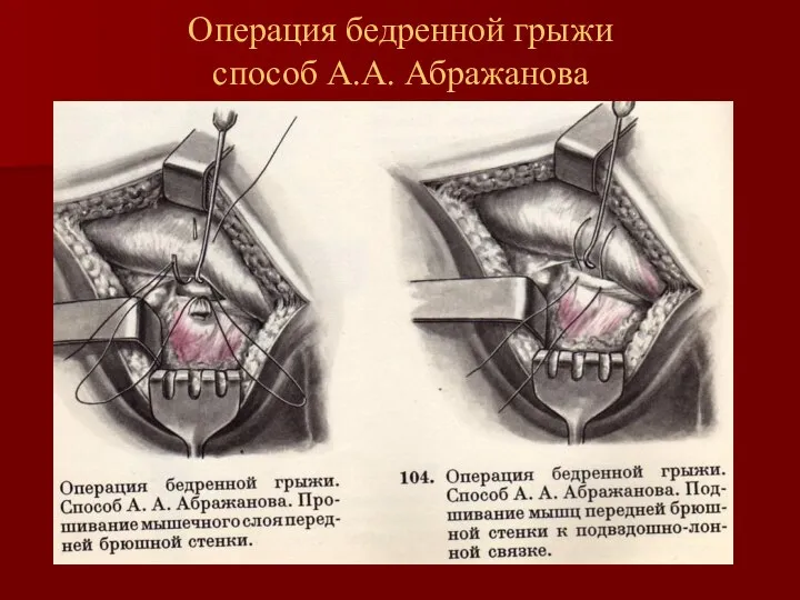 Операция бедренной грыжи способ А.А. Абражанова