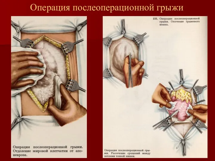 Операция послеоперационной грыжи