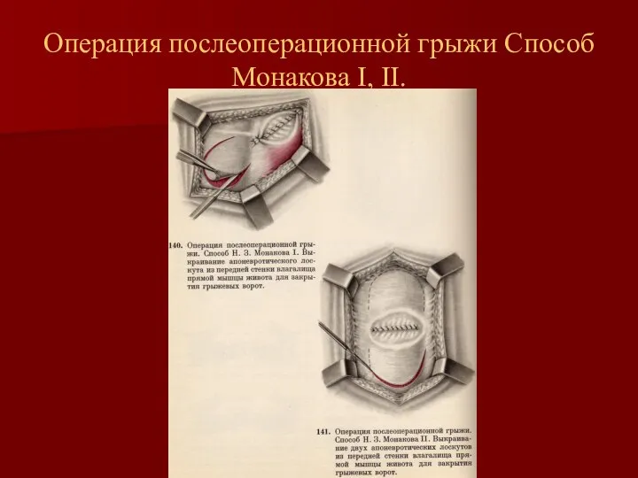 Операция послеоперационной грыжи Способ Монакова I, II.