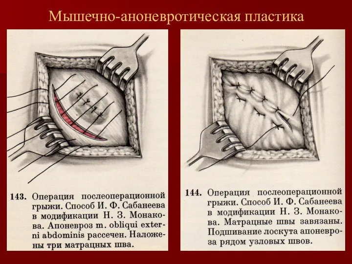 Мышечно-аноневротическая пластика