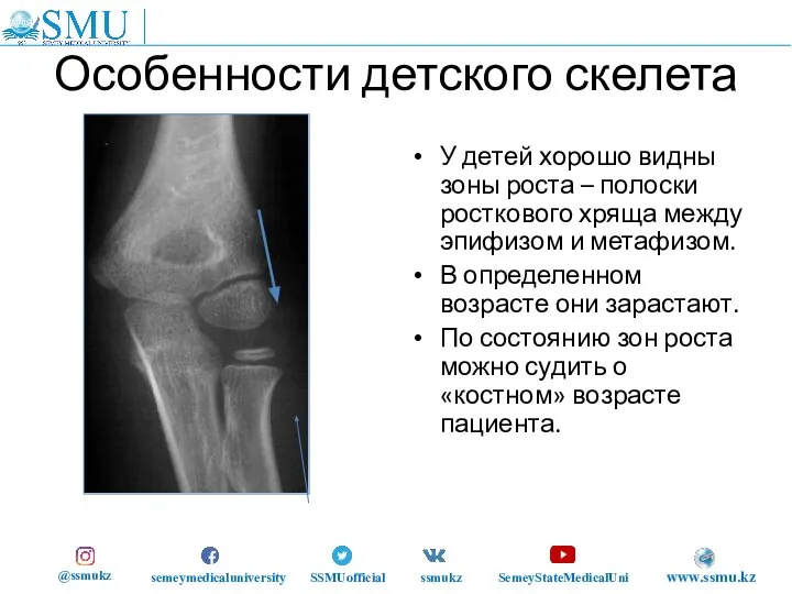 Особенности детского скелета У детей хорошо видны зоны роста – полоски росткового