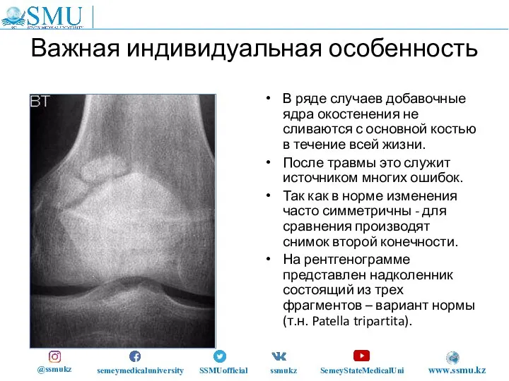 Важная индивидуальная особенность В ряде случаев добавочные ядра окостенения не сливаются с