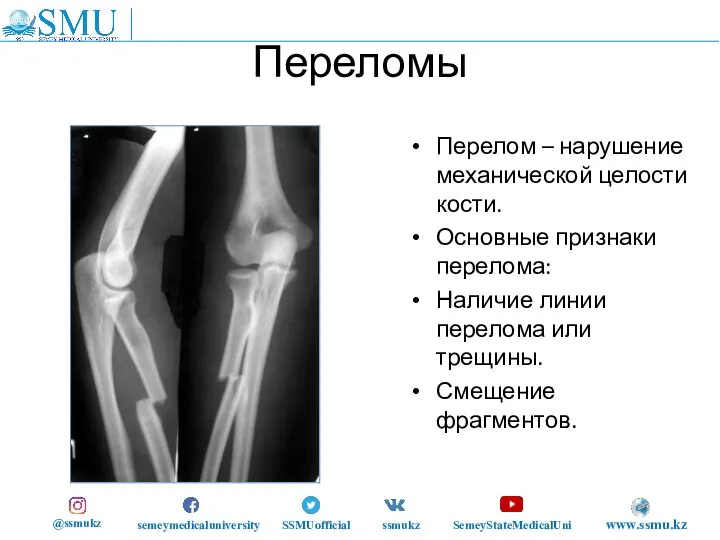 Переломы Перелом – нарушение механической целости кости. Основные признаки перелома: Наличие линии