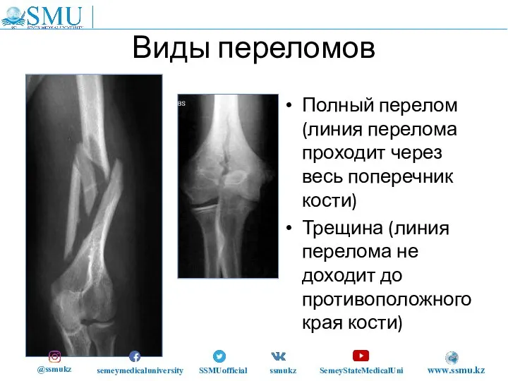 Виды переломов Полный перелом (линия перелома проходит через весь поперечник кости) Трещина