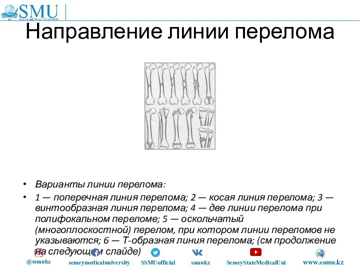 Направление линии перелома Варианты линии перелома: 1 — поперечная линия перелома; 2