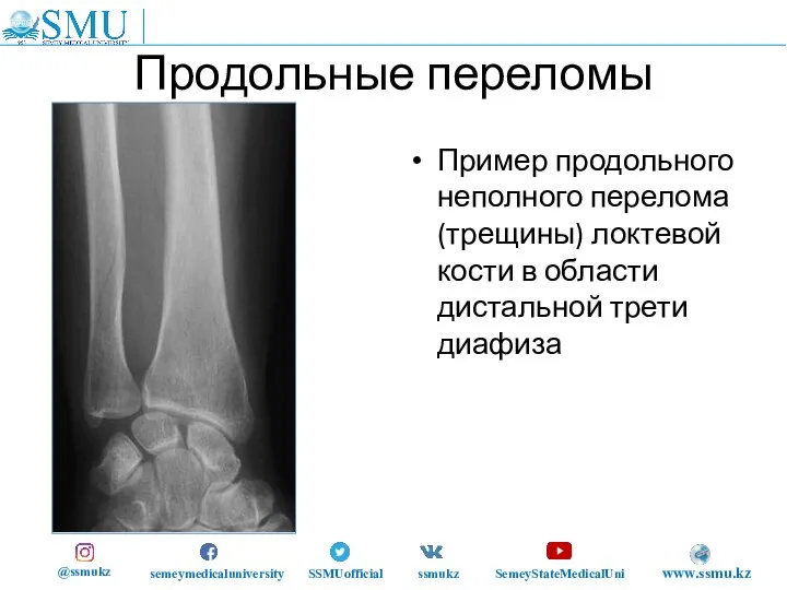 Продольные переломы Пример продольного неполного перелома (трещины) локтевой кости в области дистальной