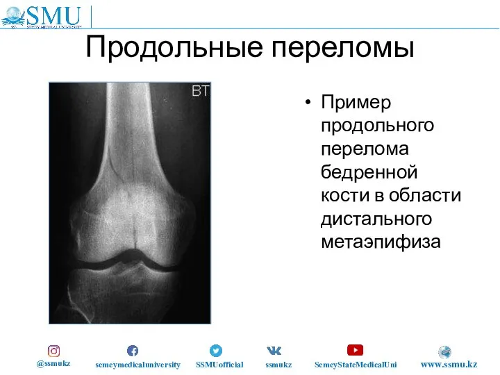 Продольные переломы Пример продольного перелома бедренной кости в области дистального метаэпифиза @ssmukz