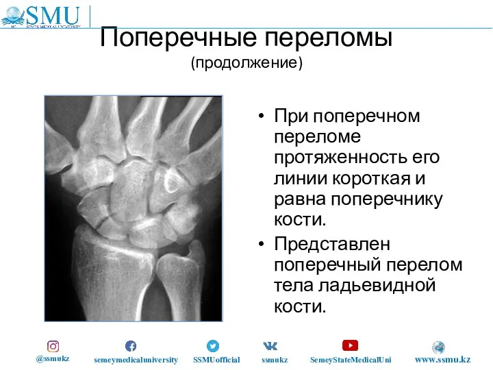 Поперечные переломы (продолжение) При поперечном переломе протяженность его линии короткая и равна