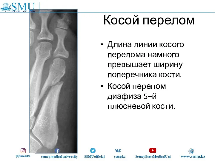 Косой перелом Длина линии косого перелома намного превышает ширину поперечника кости. Косой