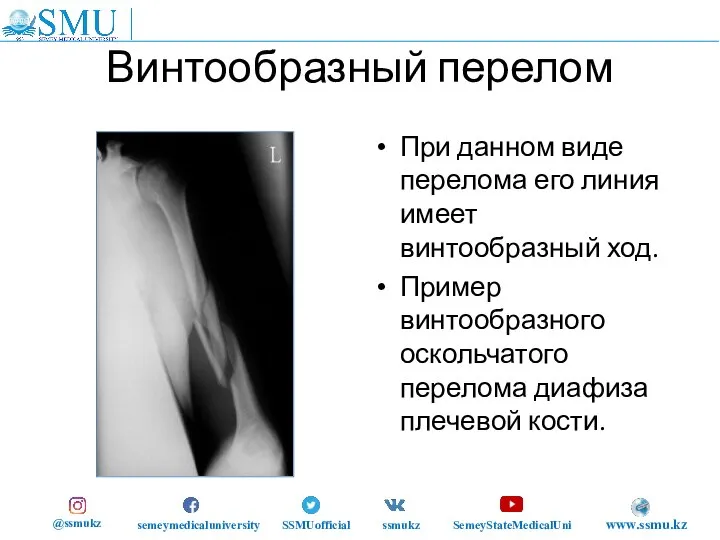 Винтообразный перелом При данном виде перелома его линия имеет винтообразный ход. Пример