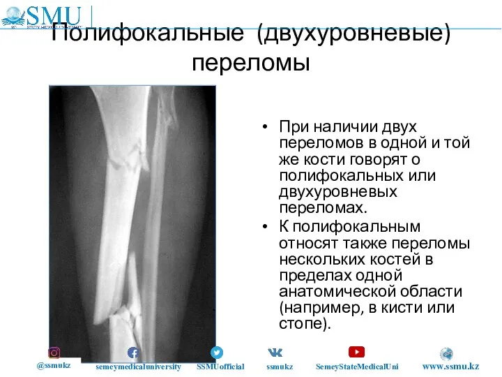 Полифокальные (двухуровневые) переломы При наличии двух переломов в одной и той же