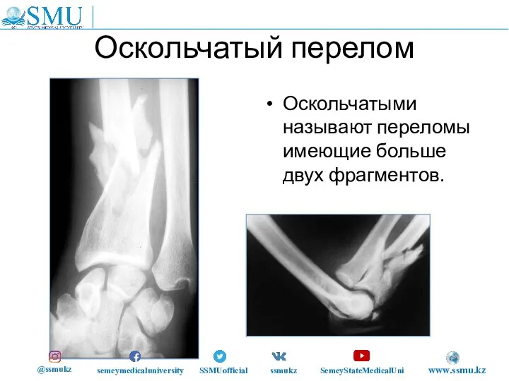Оскольчатый перелом Оскольчатыми называют переломы имеющие больше двух фрагментов. @ssmukz semeymedicaluniversity SSMUofficial ssmukz SemeyStateMedicalUni www.ssmu.kz