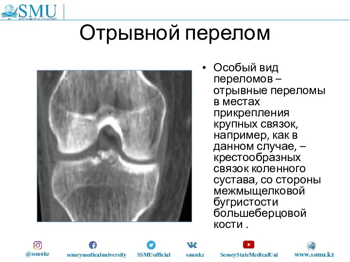 Отрывной перелом Особый вид переломов – отрывные переломы в местах прикрепления крупных