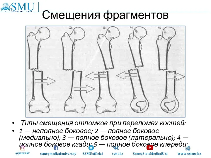 Смещения фрагментов Типы смещения отломков при переломах костей: 1 — неполное боковое;