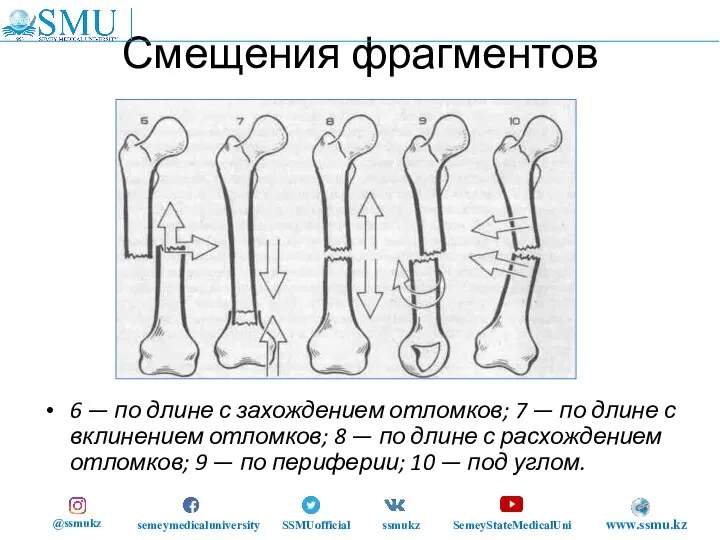 Смещения фрагментов 6 — по длине с захождением отломков; 7 — по