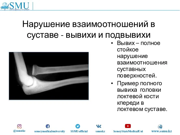 Нарушение взаимоотношений в суставе - вывихи и подвывихи Вывих – полное стойкое