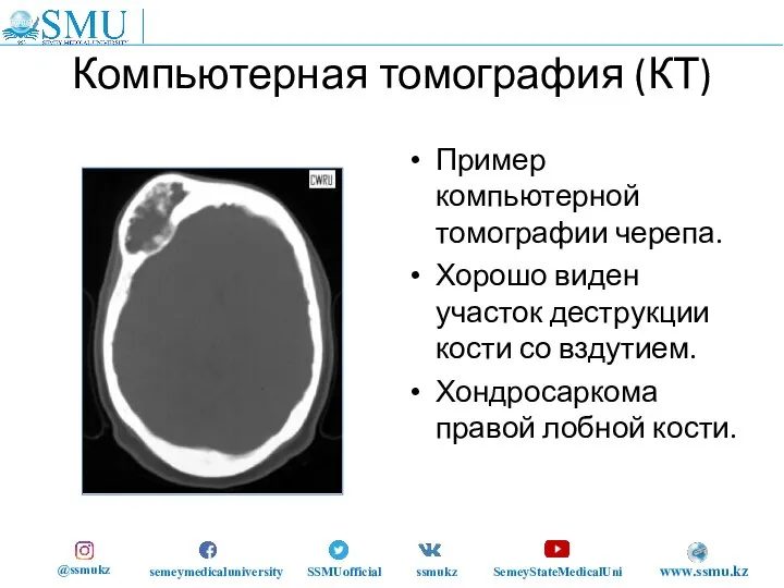 Компьютерная томография (КТ) Пример компьютерной томографии черепа. Хорошо виден участок деструкции кости