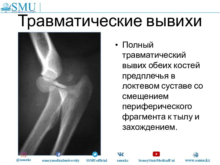 Травматические вывихи Полный травматический вывих обеих костей предплечья в локтевом суставе со