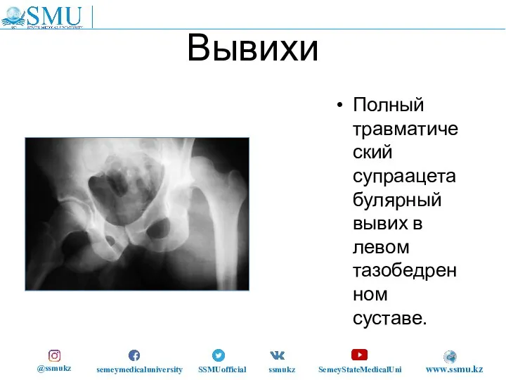 Вывихи Полный травматический супраацетабулярный вывих в левом тазобедренном суставе. @ssmukz semeymedicaluniversity SSMUofficial ssmukz SemeyStateMedicalUni www.ssmu.kz