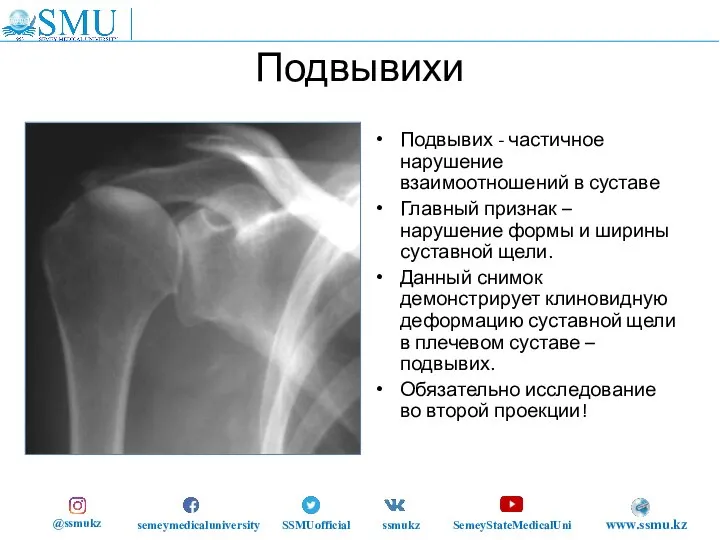 Подвывихи Подвывих - частичное нарушение взаимоотношений в суставе Главный признак – нарушение