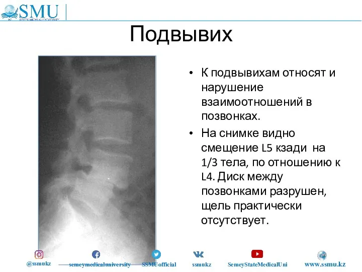 Подвывих К подвывихам относят и нарушение взаимоотношений в позвонках. На снимке видно