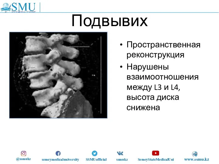 Подвывих Пространственная реконструкция Нарушены взаимоотношения между L3 и L4, высота диска снижена