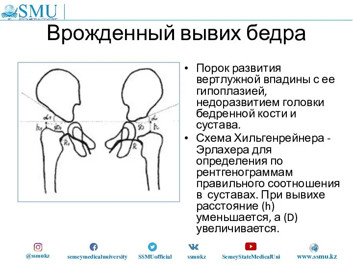 Врожденный вывих бедра Порок развития вертлужной впадины с ее гипоплазией, недоразвитием головки