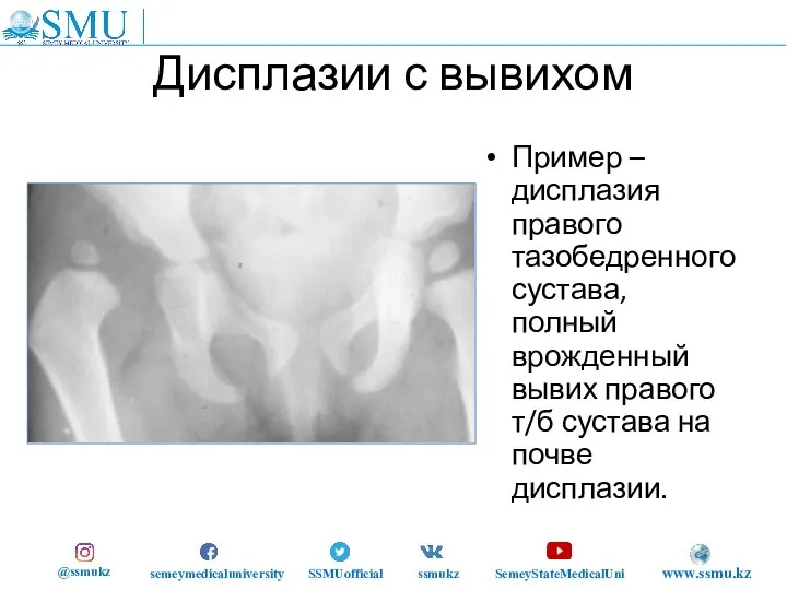 Дисплазии с вывихом Пример – дисплазия правого тазобедренного сустава, полный врожденный вывих